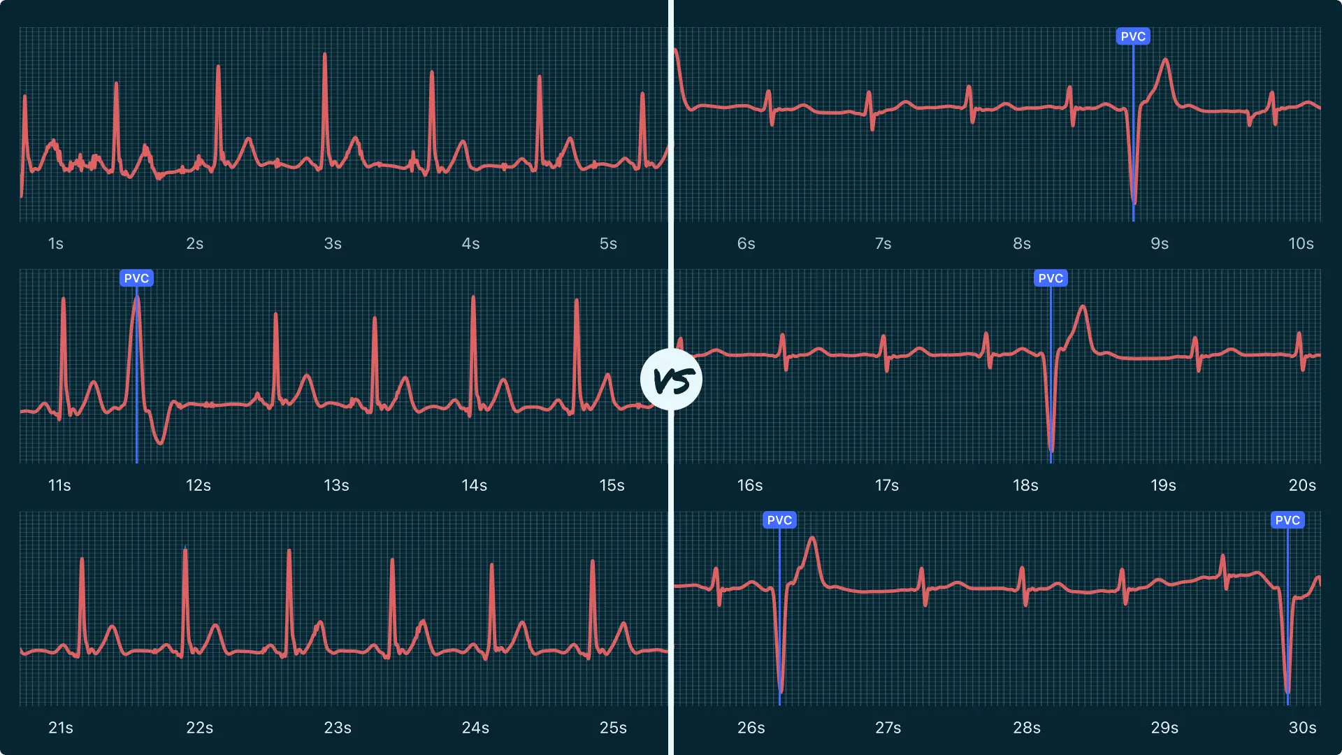 Premature Ventricular Contraction (Single) Vs. Premature Ventricular